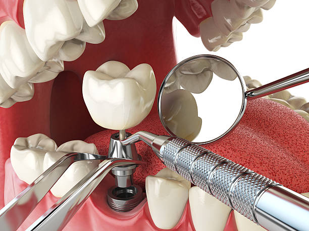 Best Emergency Tooth Extraction in El Macero, CA